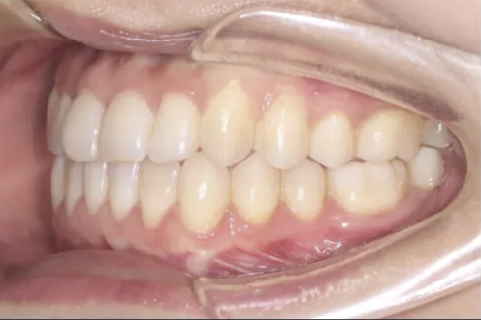 After Invisalign treatment - straight, beautiful smile