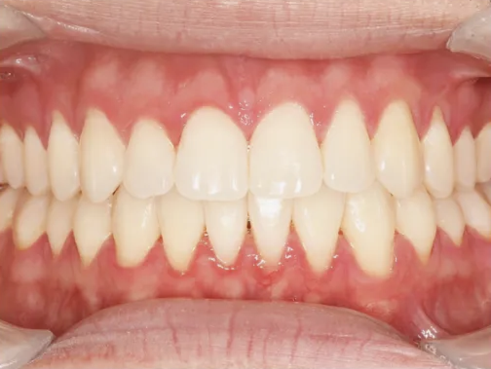 After Invisalign treatment - closed gaps
