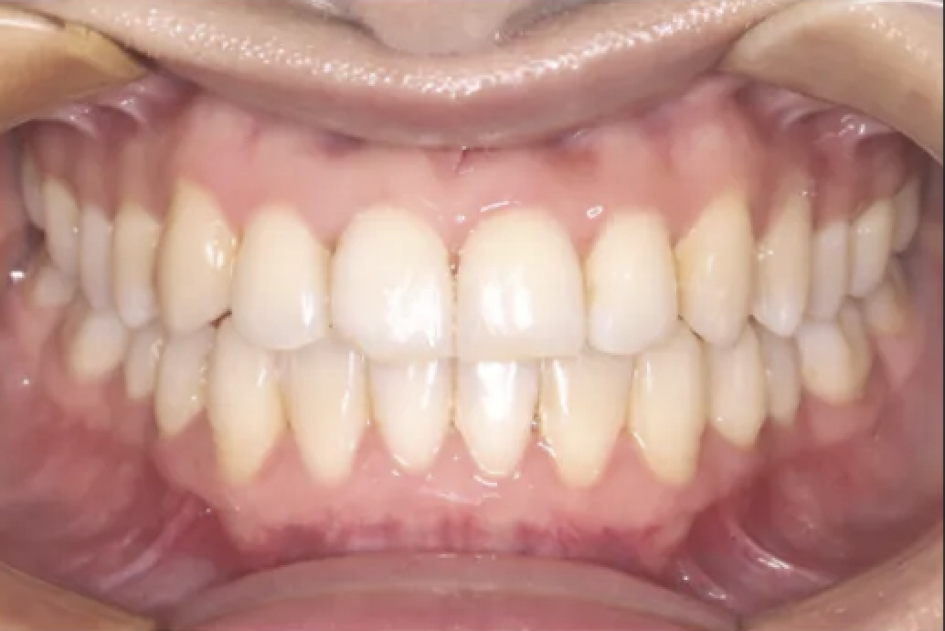 After Invisalign treatment - perfect alignment