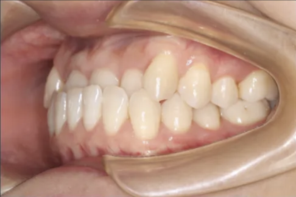Before Invisalign treatment - crowded teeth