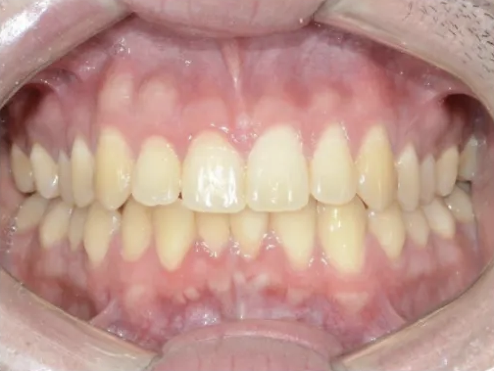 Before Invisalign treatment - gaps between teeth