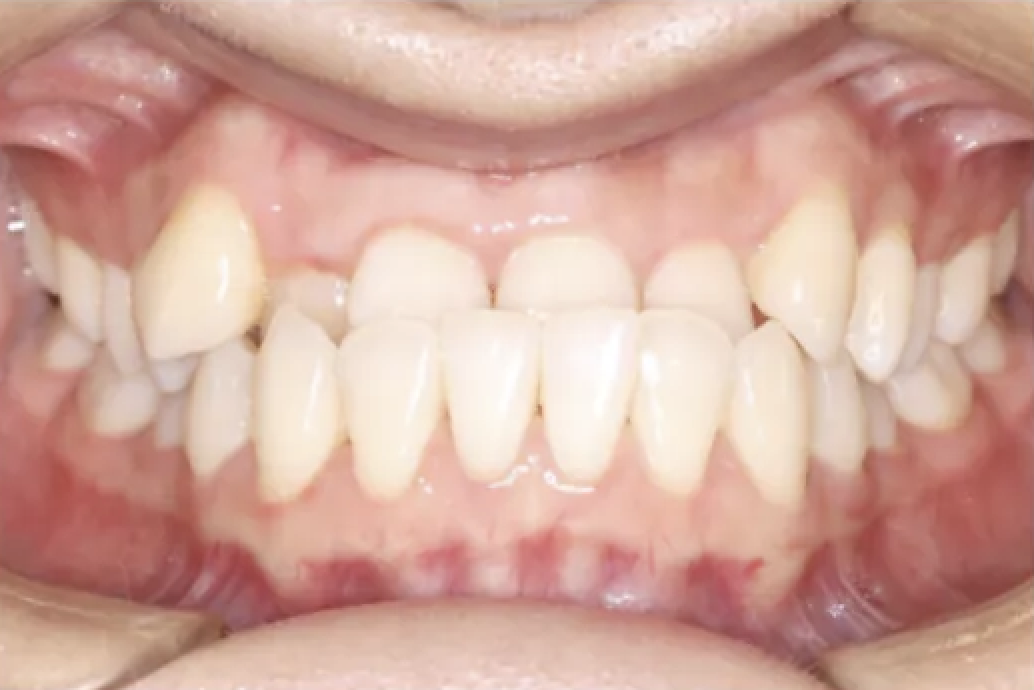 Before Invisalign treatment - misaligned bite