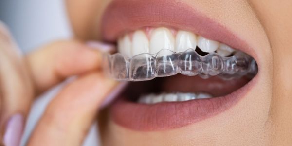 Invisalign clear aligners displayed on a clean white surface, showing the nearly transparent appearance of the orthodontic treatment