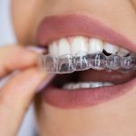 The Truth About Invisalign