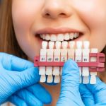 The Truth About Veneers